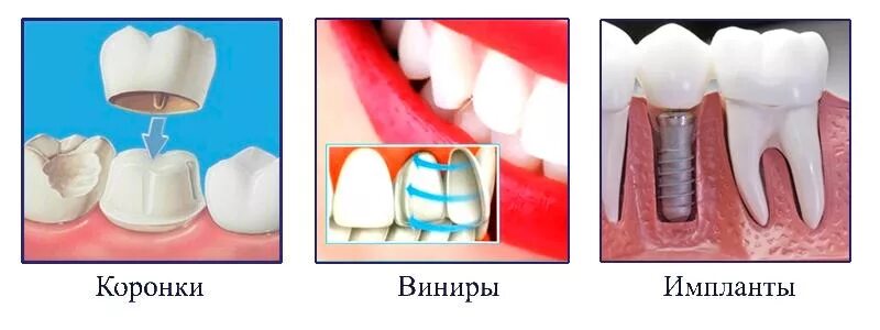 Коронки керамика на передние зубы. Металлоакриловые коронки. Металлокерамическая коронка и диоксид циркония. Диоксид циркония коронки. Металлокерамика и безметалловая керамика.