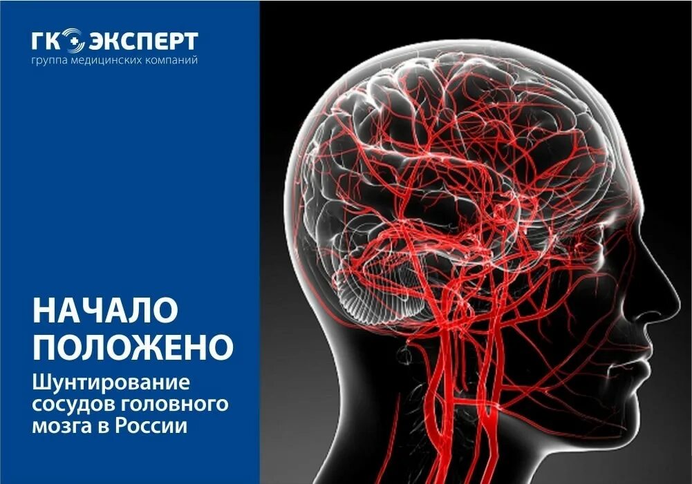 Сосуды головного мозга отзывы. Шунтирование артерий головного мозга. обследование сосудов головного мозга. сосуды головного мозга названия. обследование сосудов головного мозга и шеи.