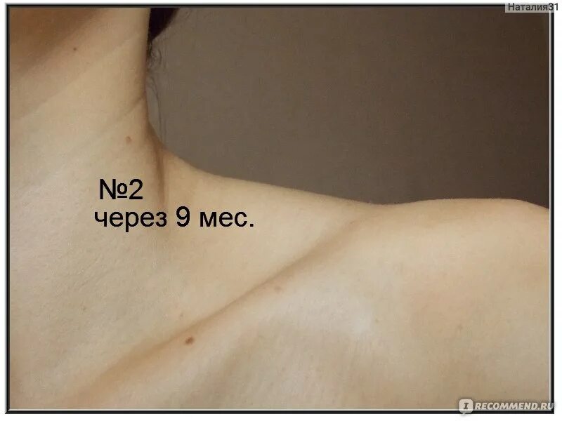 Удаление родинок (невусов) лазером в клинике лазерной хирургии "Градиент"