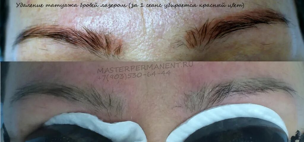 красные брови после удаления лазером. удаление лазером красных бровей. удаление лазером красных бровей. удаление перманентного макияжа бровей лазером. удаление татуажа лазером до и после фото.