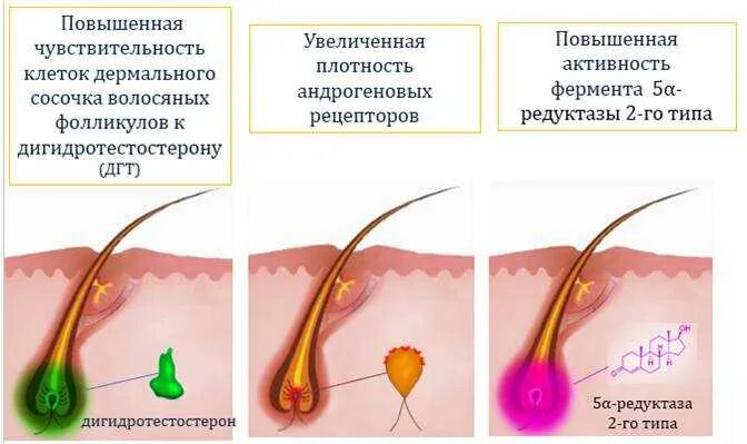 Выпадают волосы гормональное. Волосяная луковица. Волосяные фолликулы и дигидротестостерон. Выпадение волос и гормоны.