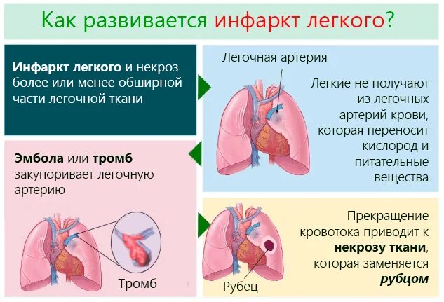 Кровь в легких птиц. Инфаркт легкого клинические рекомендации. Причины развития инфаркта легкого. Инфаркт легкого симптомы.