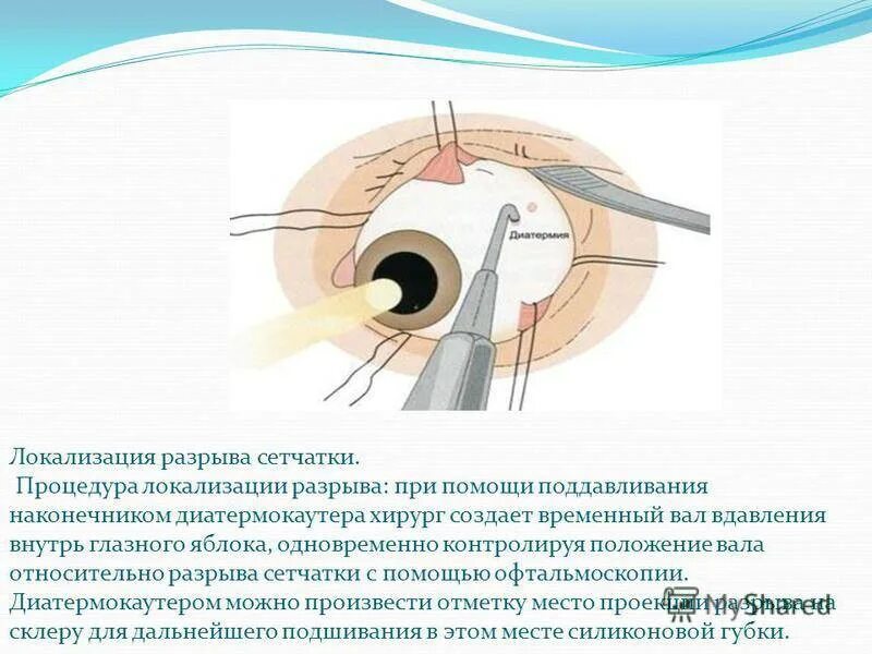 Глазное яблоко разрыв сетчатки. Витрэктомия при отслойке сетчатки. Строение глаза разрыв сетчатки.