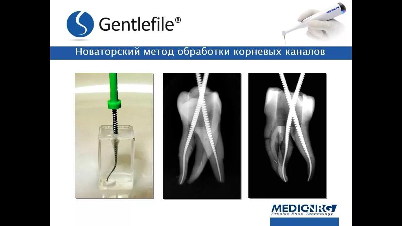 Обработка корневых каналов техники. Эндодонтическая система Gentlefile. Эндодонтические инструменты для расширения корневого канала. Методики обработки корневых каналов. Эндодонтия обработка корневых каналов.