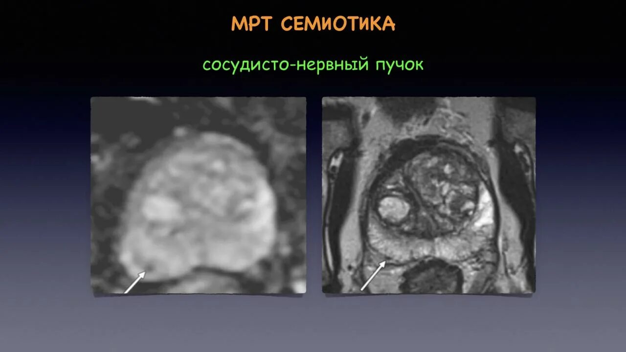 Pi-rads 2 предстательной железы. Pirads мрт. Pi rads классификация мрт. Pi rads 2.1 классификация мрт. Аденома простаты мрт