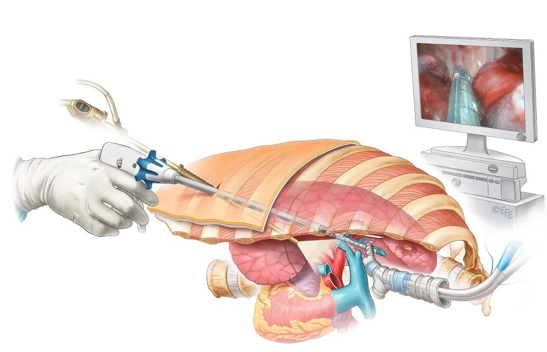 Торакоскопия (плевроскопия). Торакоскопия и видеоторакоскопия. Эмпиема плевры торакоскопия. Видеоторакоскопия резекция легкого. Биопсия легких как проводится