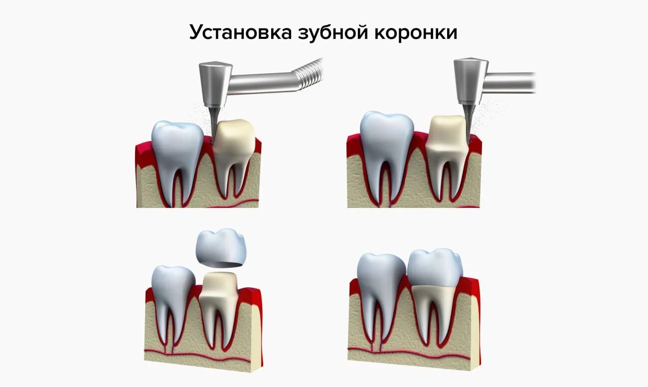 Конструкция зубной коронки. Установление коронки на зуб.