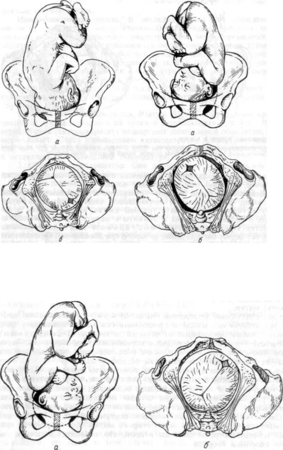 Положение плода акушерское. Ягодичное предлежание 2 позиция передний вид. Продольное предлежание тазовое 2 позиция передний вид. Положение плода продольное предлежание тазовое. Тазовое предлежание 2 позиция.