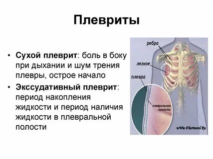 Плеврит симптомы