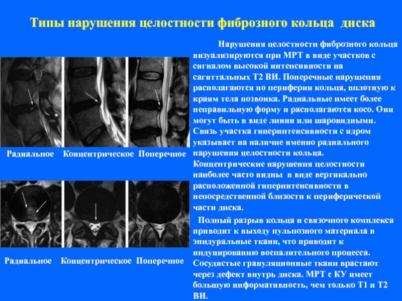 Разрыв фиброзного кольца межпозвоночного диска. Межпозвоночный диск повреждение фиброзного кольца. Грыжа межпозвоночного диска разрыв фиброзного кольца. Разрыв фиброзного кольца диска.