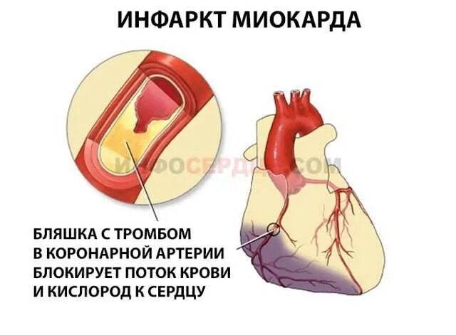 Инфаркт миокарда сердце. Сердце после микроинфаркта. Инфаркт миокарда микро. Симптомы микроинфаркта у женщин