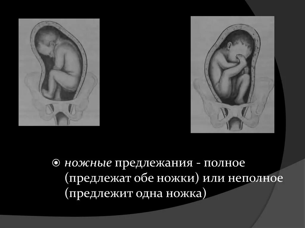 Тазовое предлежание показание. Полное ножное предлежание плода. Тазовое ножное предлежание плода. Неполное ножное предлежание плода. Тазовое предлежание плода ножное предлежание плода.