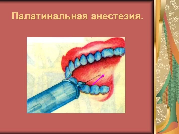 Палатинальная анестезия методика. Палатинальная анестезия верхней челюсти. Большая небная анестезия. Большая небная анестезия. Большая небная анестезия.