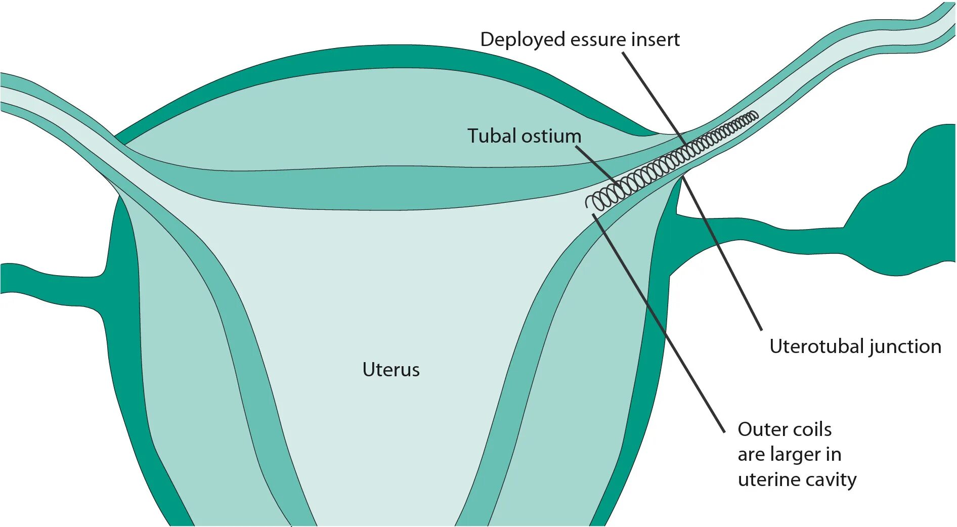 Гистероскопическая стерилизация Essure. Хирургическая стерилизация маточных труб. Непроходимость маточных труб. Перекрут маточной трубы. Если месячные если перевязать трубы