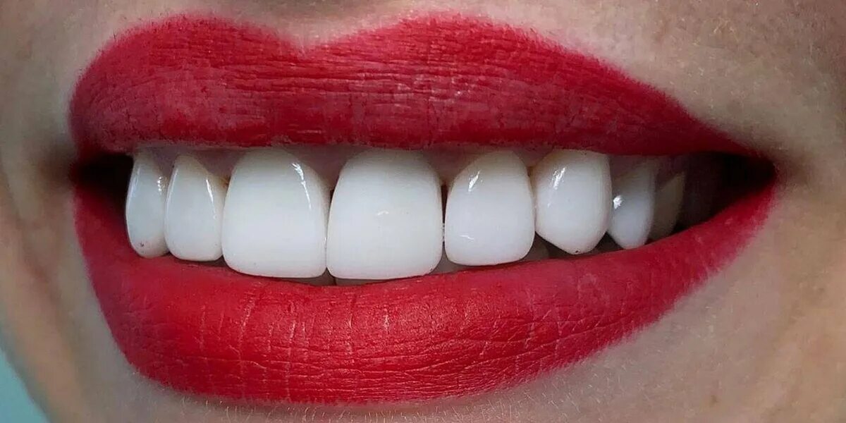 Виниры из композитного материала. Фотокомпозитные виниры.