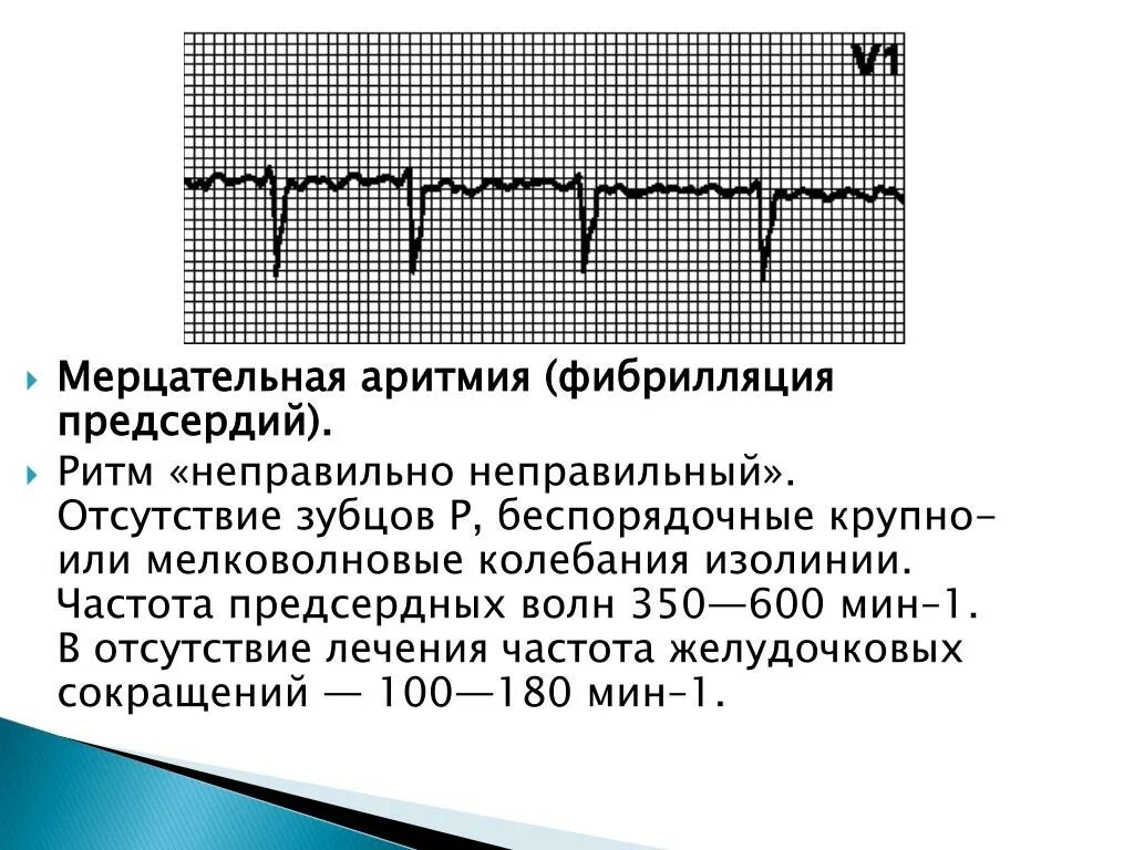 Аритмичные тоны сердца. Ритм фибрилляции предсердий ЭКГ. Мерцательная аритмия желудочков. Мерцательная аритмия на ЭКГ пароксизмальная форма. ЭКГ Мерцательная аритмия мерцание желудочков.