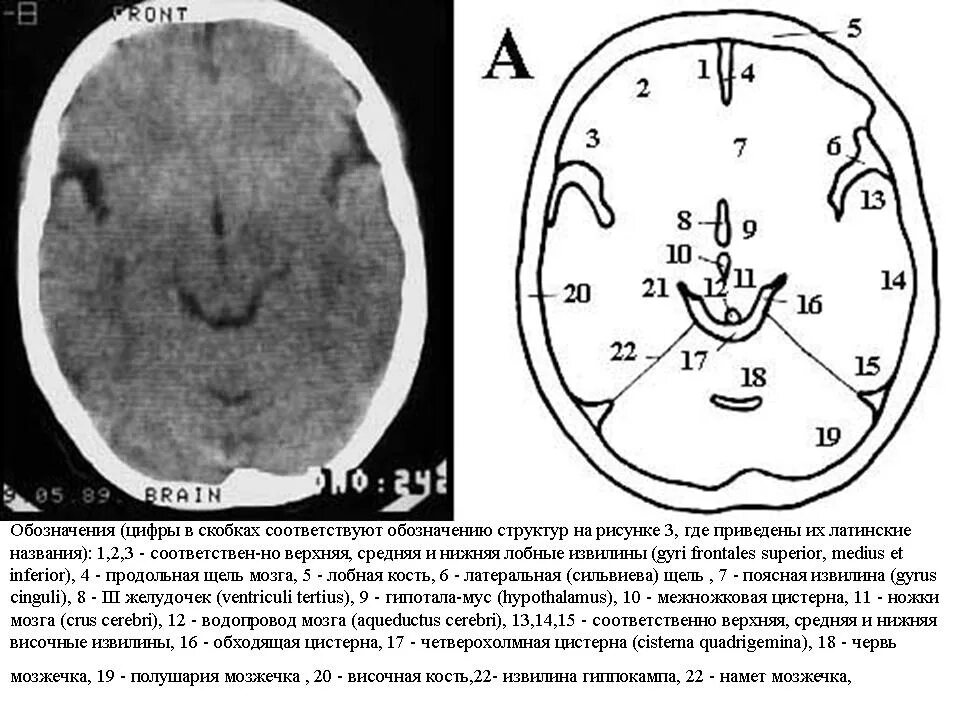 Цистерны мозга расширены. Базальная цистерна мозга кт. Базальные цистерны головного мозга кт. Базальные цистерны головного мозга на мрт. Межножковая цистерна кт.