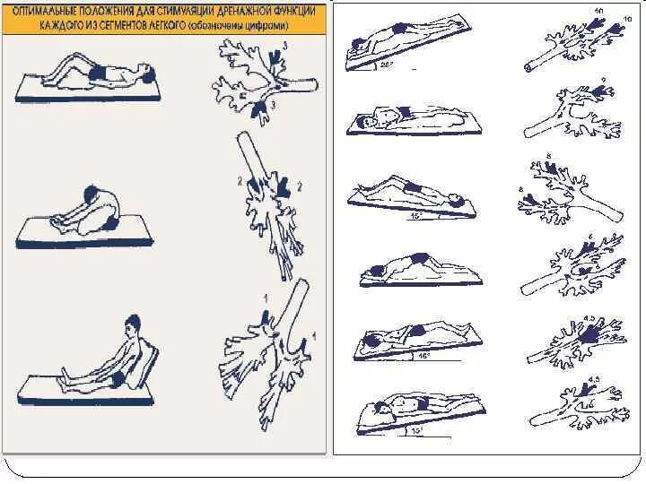 Позиционный дренаж при бронхоэктатической болезни. Бронхоэктатическая болезнь Постуральный дренаж. Постуральный дренаж грудной клетки. Постуральный дренаж при бронхоэктатической болезни. Постуральный массаж