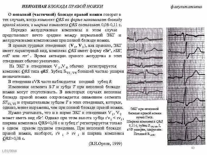 Неполная блокада правой ножки это опасно. Блокада ПНПГ на ЭКГ. Неполная блокада правой ножки пучка Гиса вариант нормы. Неполная блокада правой ножки пучка Гиса. Неполная блокада правой ножки Гиса на ЭКГ.