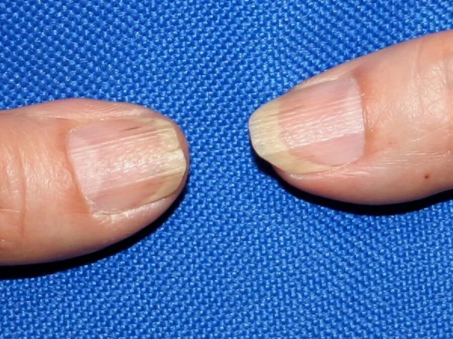 Как определить заболеваемость по ногтям. Состояние здоровья по ногтям. Определить заболевание по ногтям. Болезни ногтей на руках таблица. Как по ногтям определить заболевание человека.