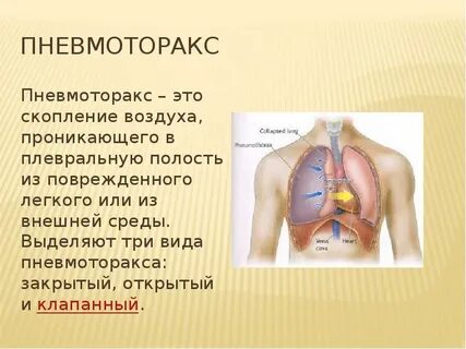 Пневмоторакс это скопление воздуха в