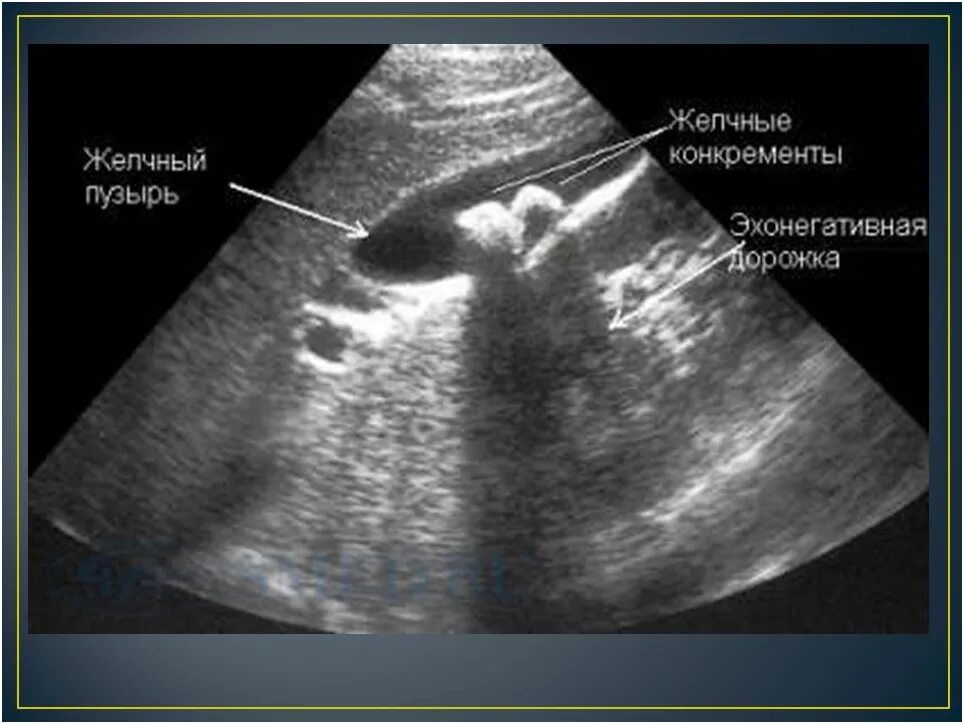 Узи жкб. Конкременты желчного УЗИ. Конкременты желчного пузыря УЗИ. Конкременты желчного пузыря что это такое. Холестериновые камни в желчном на УЗИ.