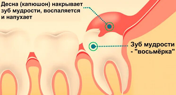 Воспаление капюшона зуба мудрости. Капюшонмудрогл зуба. Зуб мудрости воспаление десны. Можно греть зуб