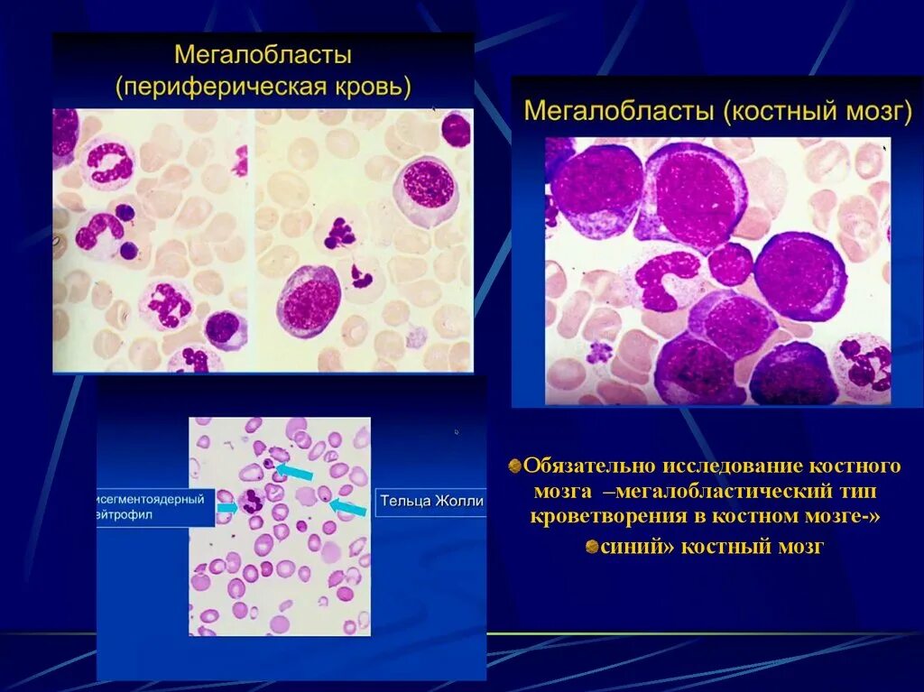 Культивирование лимфоцитов периферической крови. Мегалобластная анемия костный мозг. Мегалобластический Тип кроветворения. Мегалобластическая стадия гемопоэза. Эритробластический нормобластический Тип кроветворения.