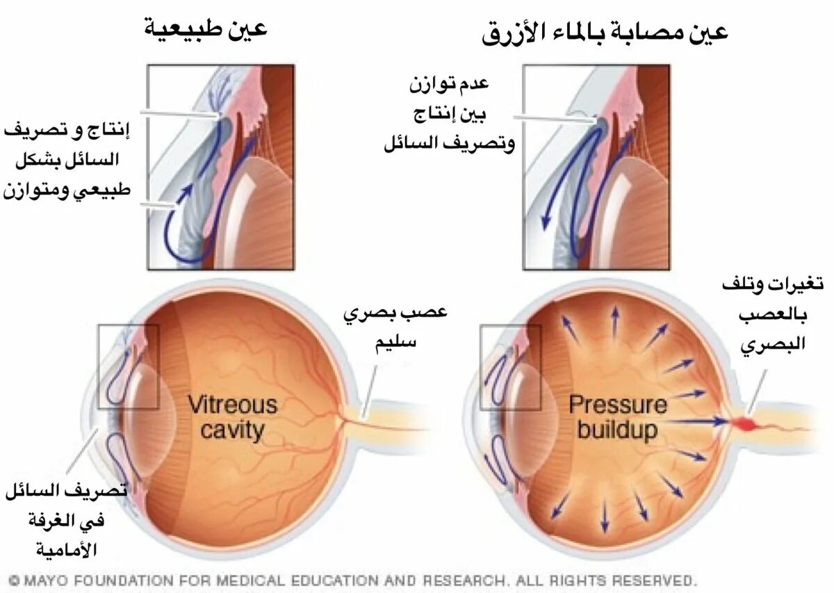 Анатомия глаза глаукома. Глаукома строение глаза. Терминальная глаукома. Глаукома латынь