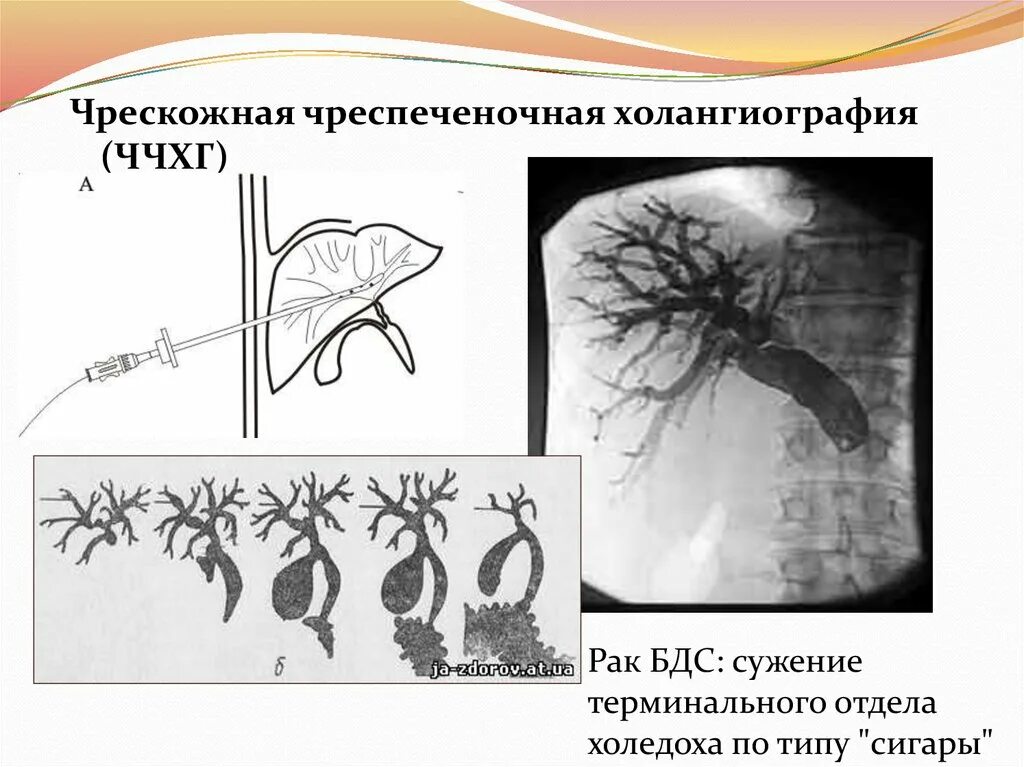 Чркзкожная чрезпеченочная холангиангиография. Острый холецистит холангиография. Чрескожная чреспеченочная холангиография. Чрескожная чреспеченочная холангиостомия. Чреспеченочная холангиография.