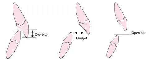 51 OVERBITE Y OVERJET NORMAL - * Braces 