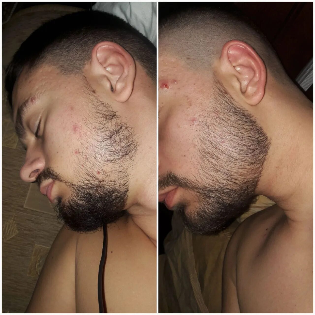 Рост волос на лице у мужчин. Миноксидил 3%. Миноксидил для бороды. Миноксидил 3 в 1.