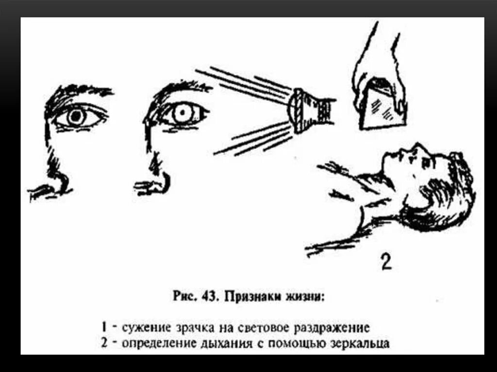 Определение пульса на сонной артерии. Признаки биологической смерти. Реакция зрачка на свет биологическая смерть.