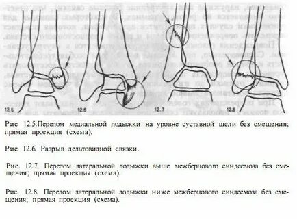 Срок лечения перелома лодыжки
