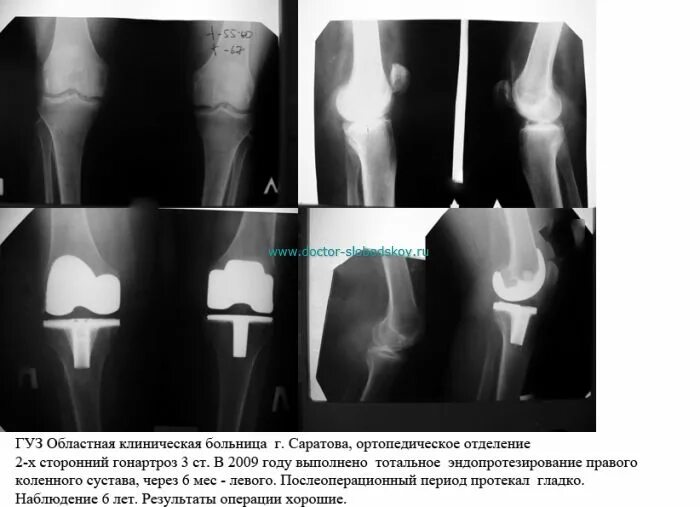 После эндопротезирования 2 суставов прошло
