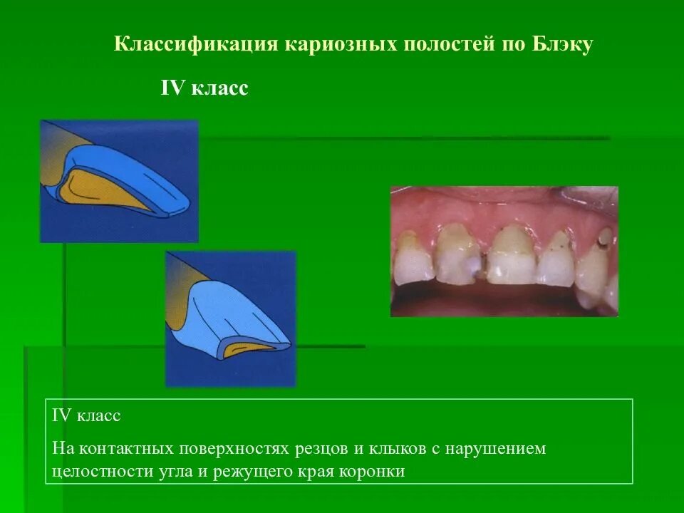 Клыки поверхность зуба. Классы полостей по Блэку. Классификация по Блеку. Полости зубов по Блэку.