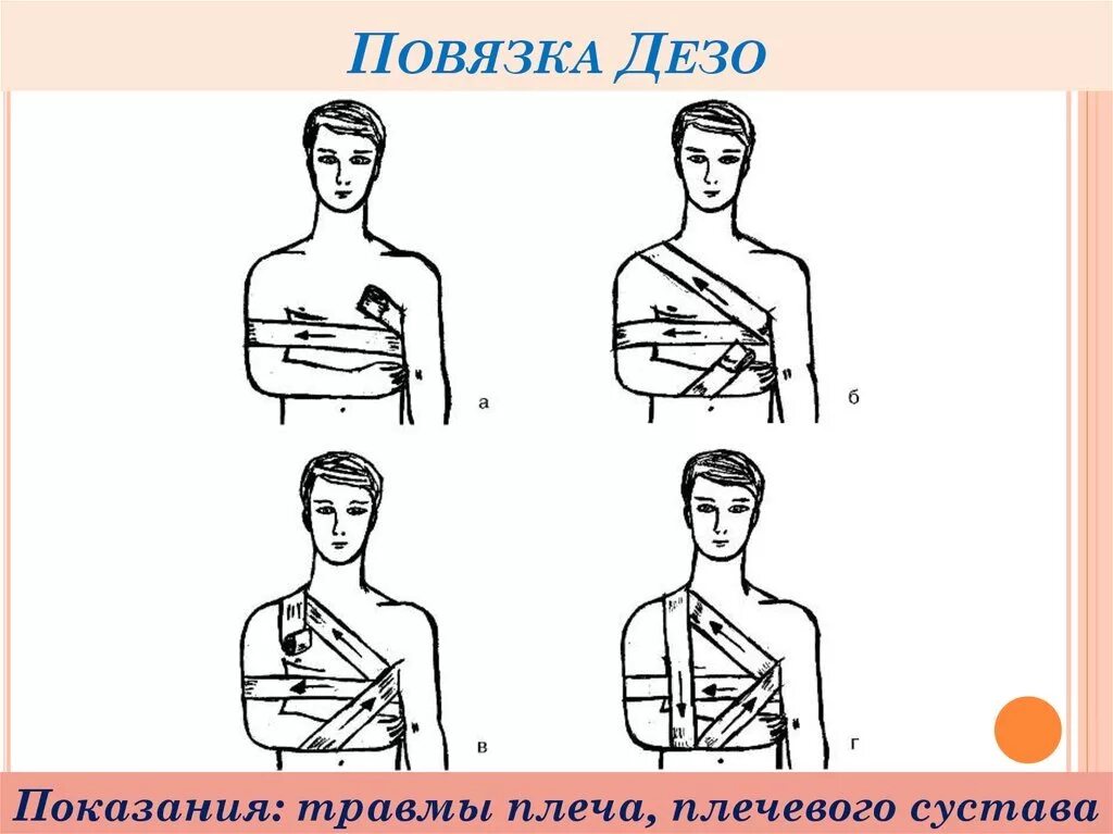 Перевязка самостоятельно. Технику наложения повязки Дезо.. Схема наложения повязки Дезо. Наложение повязки Дезо алгоритм. Повязка Дезо техника наложения.