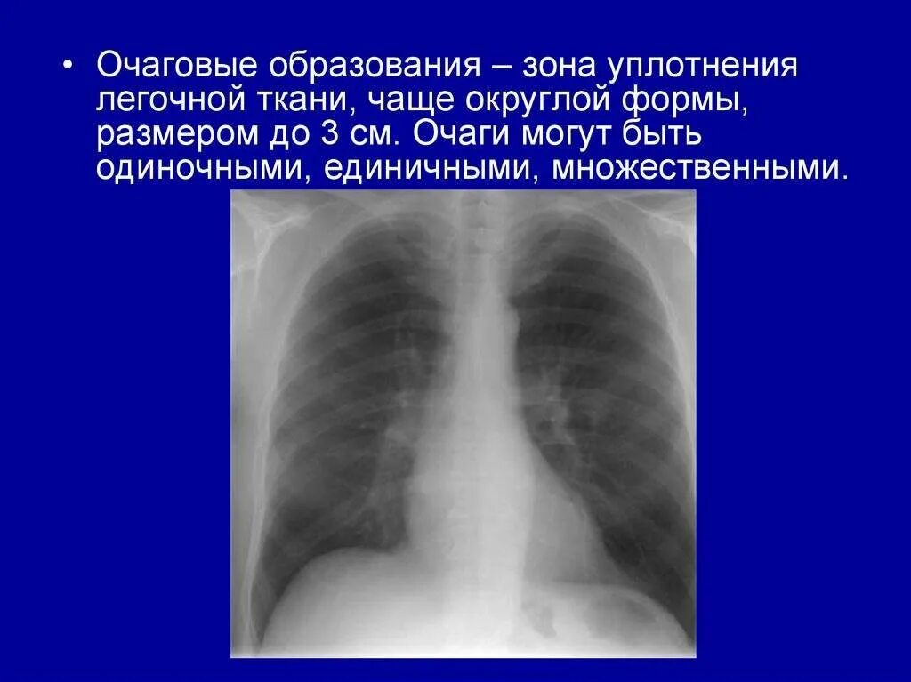 Очаговое уплотнение легочной ткани на кт. Очаговые образования в легких. Очаговое образование в левом легком. Очаговые образования легкие. Очаговых изменений правого легкого