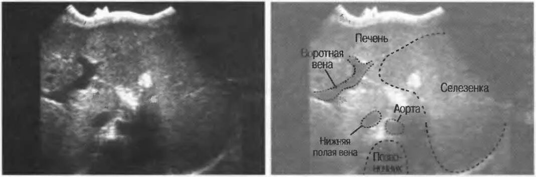Селезёночная Вена УЗИ печени. Расширение селезеночной вены на УЗИ. Гепатоспленомегалия на УЗИ. Селезеночная Вена на УЗИ норма.