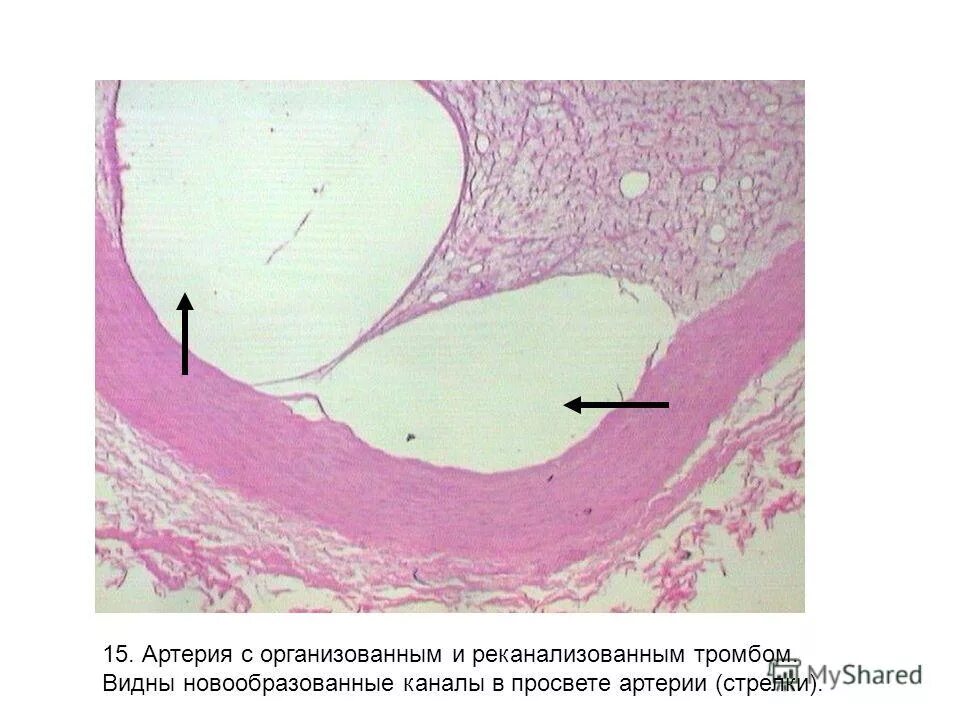 Организация тромба