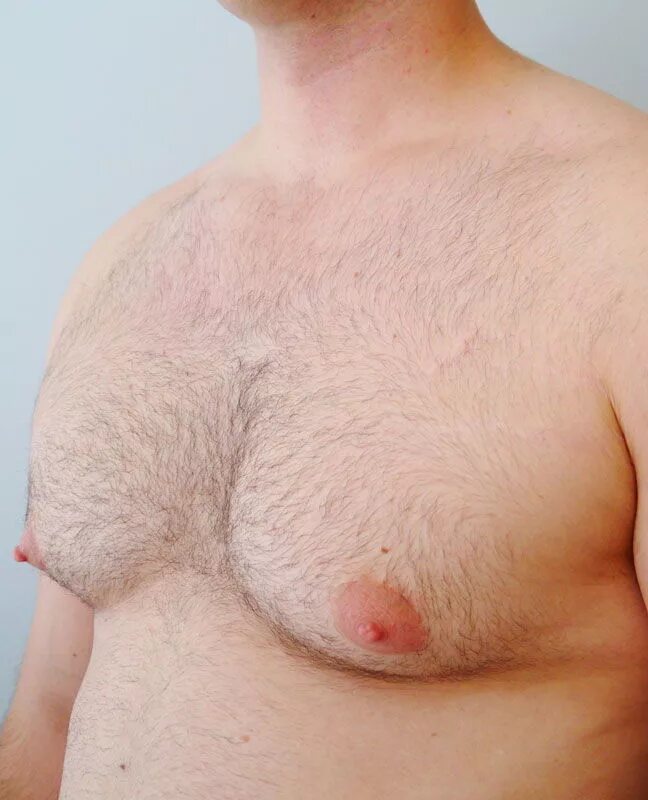 Анаполон гинекомастия. Билатеральная гинекомастия. Male breast. Красивый мужской сосок. Гипертрофированная гинекомастия.