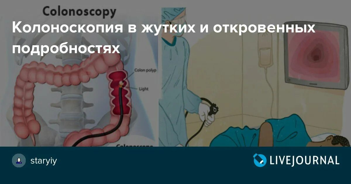 Мрт кишечника вместо колоноскопии можно. Колоноскопия кишечника. колоноскопия визуальная.