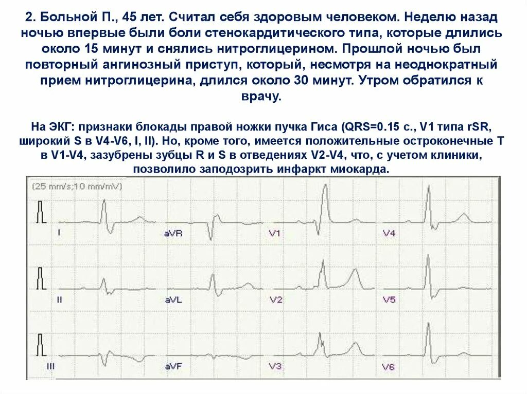 Экг метаболические изменения что это значит