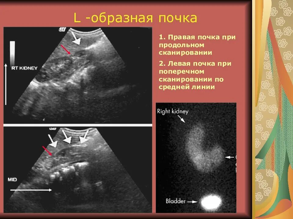 Аномалия развития почек подковообразная. L образная почка. Аномалии развития почек на узи. Подковообразная почка рентген. Аномалии сращения почек.