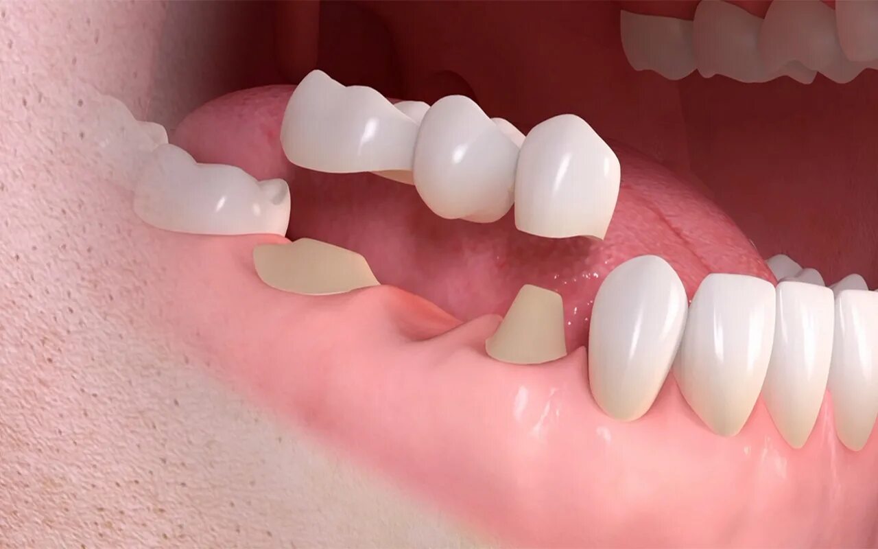 Несъемные зубные протезы. Bredent biohpp протез. Сколько стоят мосты на зубы. Штамповано-паяный мостовидный протез. Несъемные мостовидные протезы.