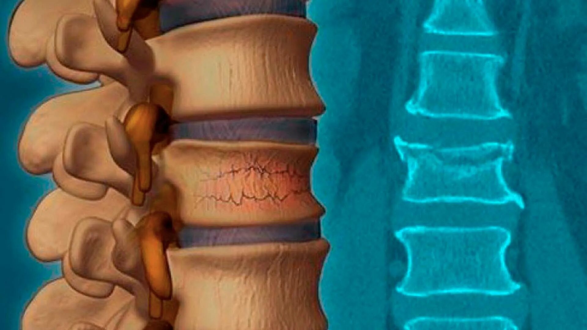Компрессионный перелом т12 позвонка позвоночника. Компрессионный перелом позвоночника т11. Компрессионный перелом тела т11 позвонка. Компрессионный перелом позвоночника т7т8. Компрессионная операция на позвоночнике