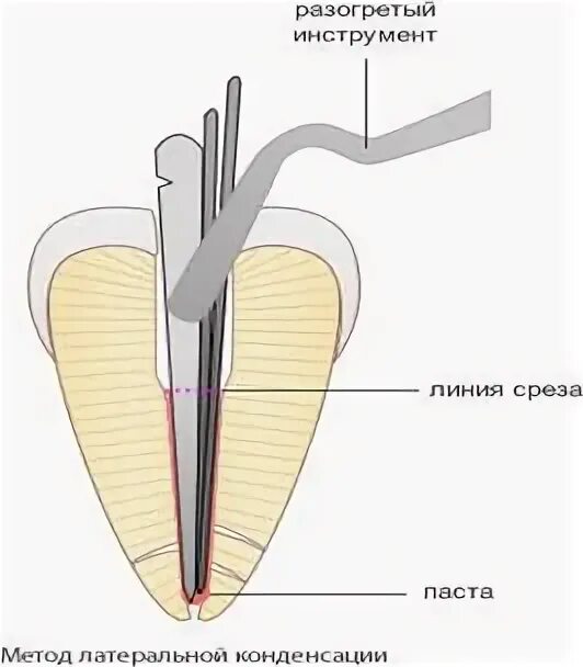Канал метода. Пломбирование 1 корневого канала(методом латеральной конденсации). гуттаперчевые штифты методом латеральной конденсации. обтурация каналов методом латеральной компакции. латеральная компакция гуттаперчи.