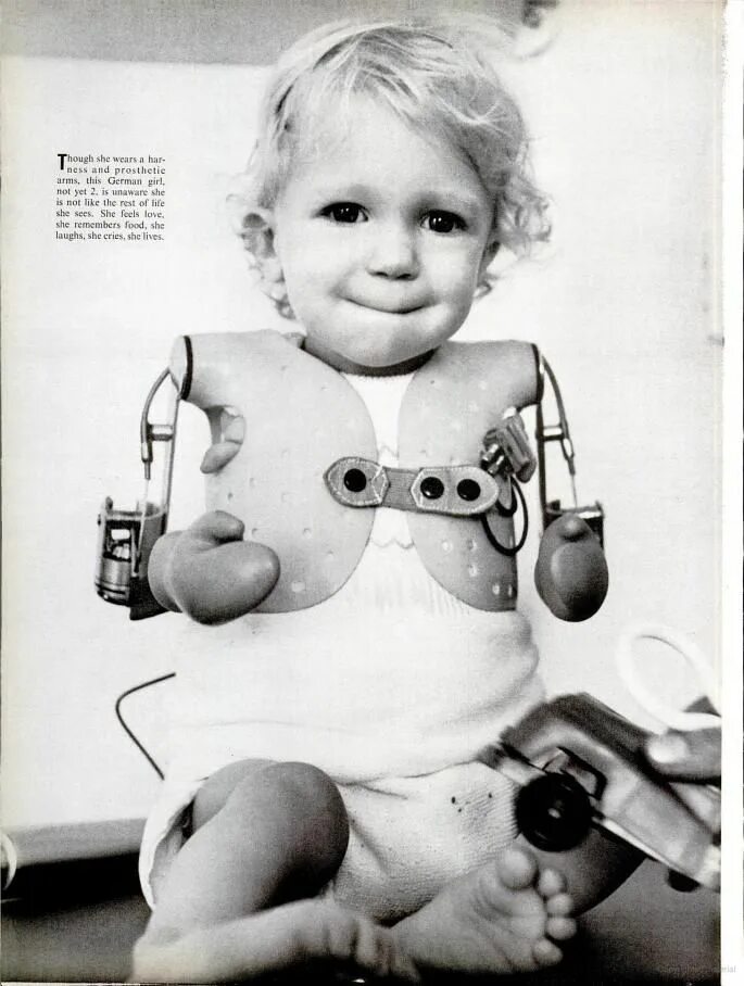 Талидомид трагедия дети. Применение талидомида. Применение талидомида. Последствия талидомида. Талидомид памятник.