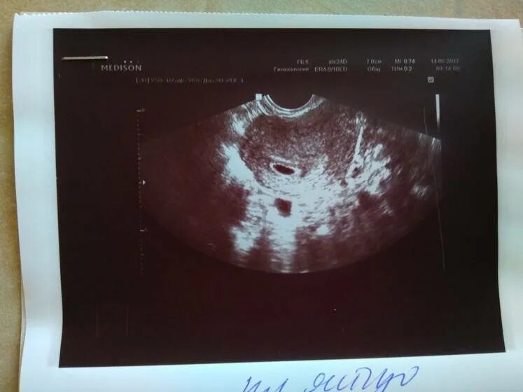 Многоплодная беременность 4 недели узи. Узи плодное яйцо 6 недель. Яйцо плодное как выглядит на сроках. Яйцо плодное как выглядит на сроках. Узи беременности 2 недели двойня.