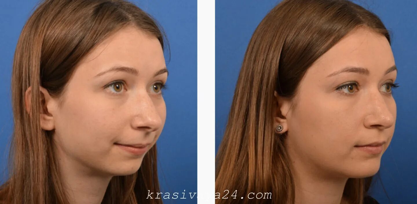 Коррекция формы бровей до и после. Исправление формы. Пластика кончика носа. Безоперационная ринопластика. Пластика нижней челюсти.